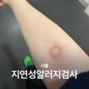 IGG4 + MAST 검사 내돈내산한 후기... • 피부 뒤집어진 사람의 지푸라기 잡기 • 지연성알러지검사 가격