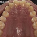 전농동 치과 에서 수면 마취 로 사랑니 4개 한 번에 발치 성공한 후기