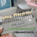 수연합치과기공소 | [구미/산동]온가족 연합 치과 치아 전문가 미백 후기 주의사항