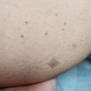 LK성형외과의원 | 광주성형외과의원 종아리보톡스 찐 후기