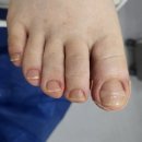 한영정형외과의원 | 수원 팔달구 중동 무좀 발톱이랑 내성발톱 치료 가능한 병원 치료 후기