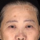 클리니크후즈후의원 | 비수술적 눈썹, 안면거상 압토스 리프팅 (라이트리프트 라인)
