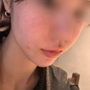 에미뜨의원 | 동탄 팔자주름 눈밑꺼짐 시술 후기