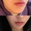 압구정피부과 코셀라리프팅 3회차 내돈내산 후기