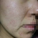 아이린피부과의원 | 여드름약 이소티논 한 통(30알) 복용후기, 간헐적으로 복용하면? with 아크더마 재생크림
