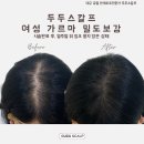 두두스칼프