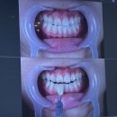 밝은e치과의원 | 신사역 치과 레브치과 치아미백 밝기 전후 차이