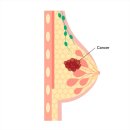 유방암 수술후 신체 변화 및 재발 방지 가이드 이미지