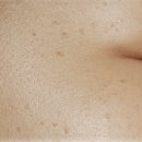 편평사마귀, 좁쌀인 줄 알고 짜면 더 번지는 이유 (이마·번짐 관리)