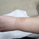 삐약이PC | 부산 화상병원, 손목 2도 화상(심재성) 치료후기_2편