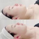 서산 리프팅 이중턱 탄력관리 1회만에 놀라운 효과 *루아뷰티*