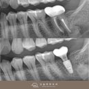 블루커스텀 치과기공소 | 발치 즉시 임플란트 심한 어금니 통증 있다면? 빠르게 회복한 사례 (#37 메가젠 블루다이아몬드)