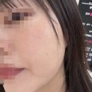 안아픈세상정웅기의원 | 둔산동피부과 톤즈의원 튠라이너 스킨보톡스 주사자국 멍 내돈내산 2주후기