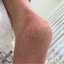 미아 발관리 레푸스 미아점 발톱 스케일링 전후 후기 - 1일차 피부과 vs 발관리샵