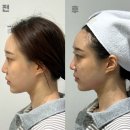 청담튠의원 | 강남 리프팅잘하는곳 셀리닉의원 TT리프팅 전후비교 청담 튠라이너 티타늄후기