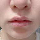 하늘성형외과의원 | 필러 내돈내산 맞구왔어요..입술필러 리모델링 2탄 리얼후기 💋 후기 길어요 ! 부산입술필러 잘하는 곳 !