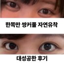 한쪽 쌍커풀 겹쌍을 한쌍으로 자연유착 수술 후기 찐 내돈내산 + 당일 상담 수술 꿀팁