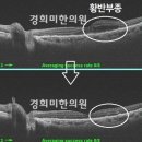 경희동의보감한의원 | 황반변성 초기 증상 황반변성 치료 후기 망막전막 원인 낭포 황반부종