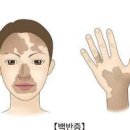 백색증 백반증 증상 원인 치료 총정리 이미지