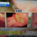 위염,위궤양,위암, 땅콩새싹/병의 근원적인 원인은 중앙토 위장으로부터 발생합니다. 이미지