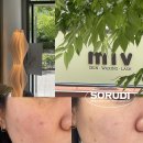 텐퍼센트갈매스칸센 | 구리 색소전문 미브스킨앤왁싱에서 기미관리 1회차 만족후기