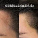 [역삼역 반영구]3자,M자 이마 헤어라인 반영구로 채운 후기
