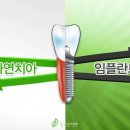 임플란티아
