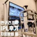 (주)아이소프트 | 안구건조증 치료 과정 기록: IPL 레이저치료, 눈찜질, 오큐소프트etc
