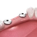 심플인플란트치과의원 이미지