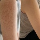 닭살이야 | 팔 모공각화증 닭살피부 홈케어 후기