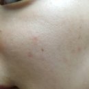 글로웰의원 | 글로웰의원)닥터주근깨 시술후기 As받으러 갔다 왔어요