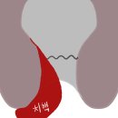 군자건항외과의원 | [후기 1편] 군자건항외과 치질 수술 항문 출혈 가려움 후기기록