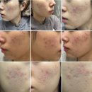 100년한의원 | &lt;11회 차&gt; 송파여드름자국 내돈내산 후기, 여드름 치료를 한의원에서 ?!