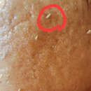 산호한의원 | 여드름 흉터, 색소침착 완화, 주름개선까지? 이스라엘 필링 후기