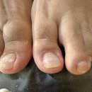 대청로25번길 | 파고드는발톱 서귀포내성발톱 관리 후기 [ 네일바다 닥터풋클린 ]
