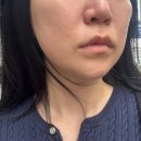 세르프리프팅 후기 소개팅 전 하기좋은 안아픈리프팅