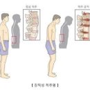 강직성 척추염 검사 원인 증상 치료 완치 가능할까? 이미지