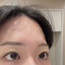아셀뷰티 - 동구 반야월로 311-13 | 강남역피부과 스킨부스터 쥬브아셀 찐찐 시술 후기/흉터자국 등