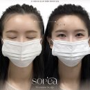 수지헤어스튜디오 | 김해헤어라인 머리 올려 묶을 때마다 신경 쓰여서 스튜디오수지 두피문신 받은 후기