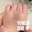 라라피부과의원 | 광주 이소성몽고반점 레이저 치료 후기(라라피부과)