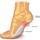 족저근막염, 누구나 걸릴 수 있는 흔한 질환 이미지