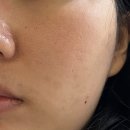 무등산한의원 | 광주 광천동 여드름치료 해율한의원 광주점 새살율안침 솔직후기