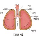 폐농양 이미지