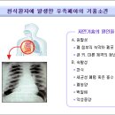 기흉 이미지