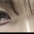 미소라인성형외과의원 | 압구정 미소라인 성형외과_쌍꺼풀 재수술 후기(극한 눈)/내 돈 내산 찐후 기