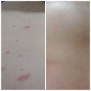설성약국 | 장미색비강진 치료(+)(또+)(+2021)