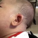 SB나눔제일의원 | 신생아 귀 교정 후기