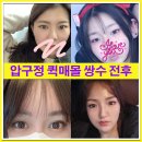디자이너성형외과의원 | 퀵매몰 왜 빠를까? 쌍꺼풀찝기 회복 기간과 쌍수전후, 쌍꺼풀수술후기 정리