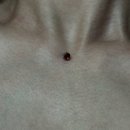 셀프피어싱 | 마이크로 더멀 피어싱 셀프 제거 후기 결국… {혐짤주의}