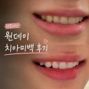[신사역 치아미백] 누런 치아 하얗게 만들고 왔어요! 레브치과 내돈내산 방문기